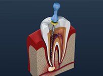 Root canal dental services