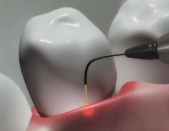 An example of laser dentistry